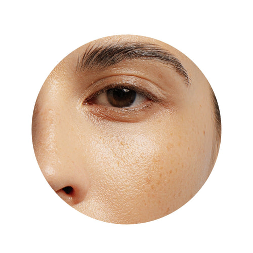 Bags & Dark Circles